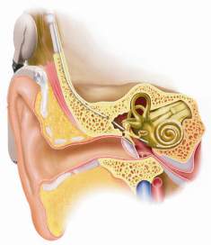 Diagram of the internal and external parts of the MED-EL ear implant