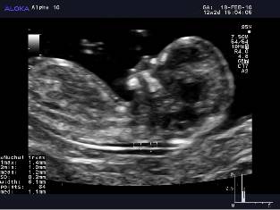 Semi-auto NT on an Aloka Alpha 10 ultrasound system