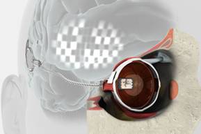 Early bionic eye prototype - electrode array