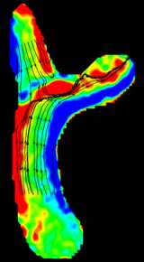 A model illustrating the direction and strength of blood flow through a child's pulmonary artery and connecting veins after certain changes are made to its shape.