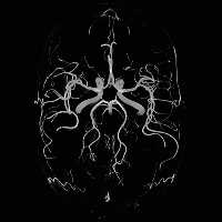 Angiography in the brain made without injection of contrast medium with the 12-channel 3T Head Matrix coil. Very high image resolution enables the visualization of blood vessels with down to 200 µm thickness.