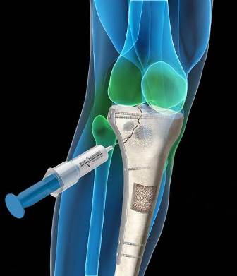 Drawing showing how bone support is used to fill bone voids