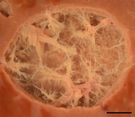 A cross section through a histotripsy lesion created in bovine liver tissue with the liquified cellular contents washed out revealing the remaining extracellular matrix. The scale bar represents 5mm. Credit: T.Khoklova/UW