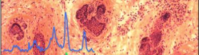 histopathology specimen of sking cancer