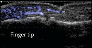 Inflammation in a finger tip