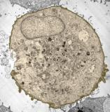 Prostate cancer cell immediately after exposure to ultrasound